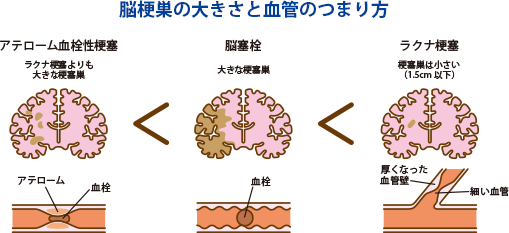 脳梗巣の大きさと血管のつまり方