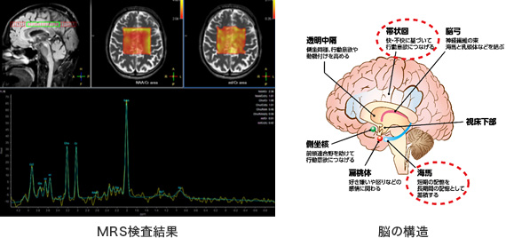 MRS：脳代謝産物計測